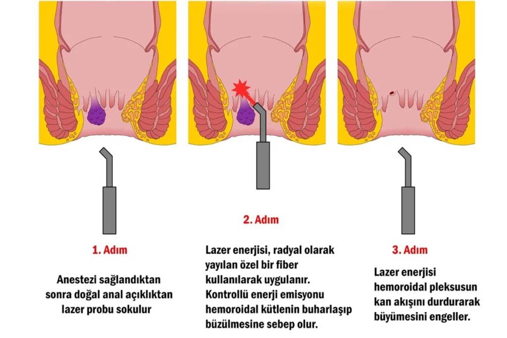 lazerle-hemoroid