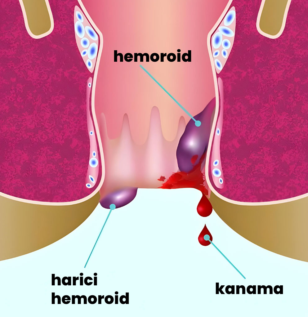 hemoroid(basur)-proktoloji
