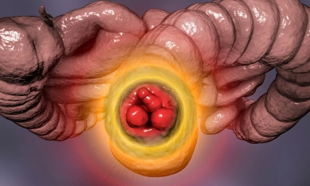 lazerle-hemoroid-tedavisi