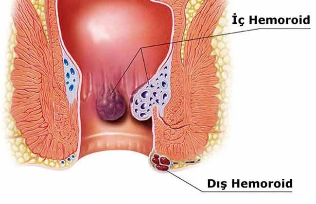 hemoroid-nedir